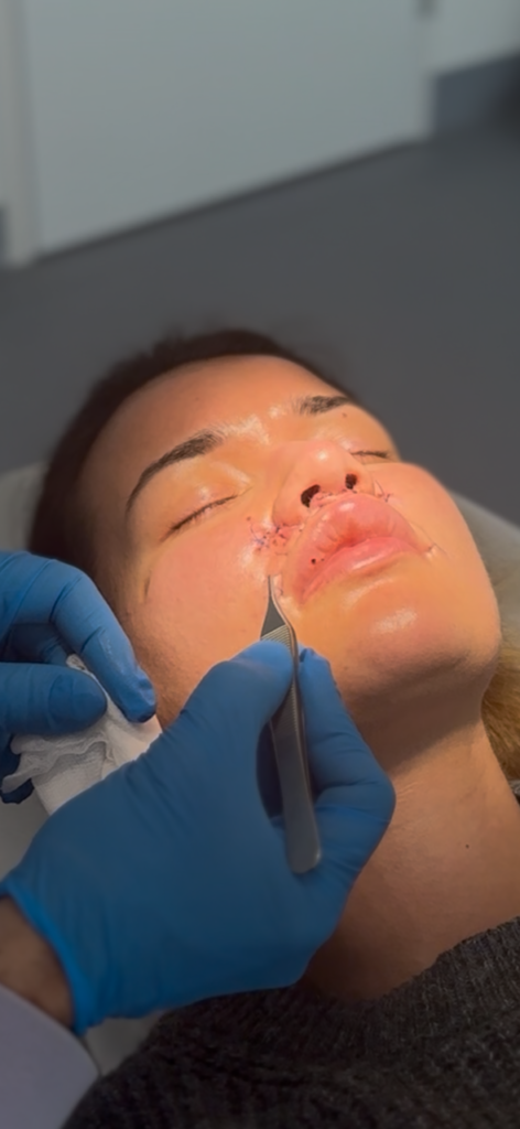 Frühe postoperative Aufnahme im Bereich von Nase und Oberlippe mit sichtbarer Schwellung.